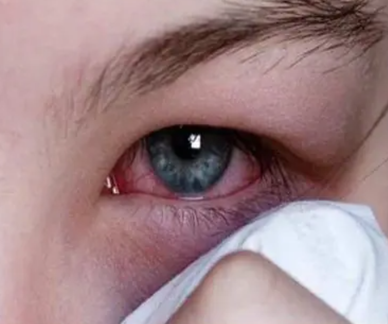 conjunctivitis